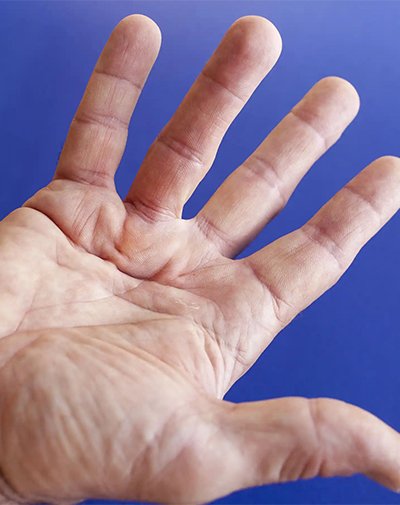 Dupuytren's Contracture of the Hand